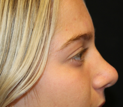 Rhinoplasty Before & After Patient #30417