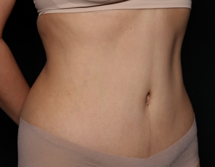Tummy Tuck Before & After Patient #30433
