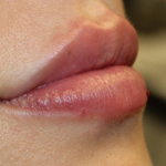 Lip Filler Before & After Patient #30466
