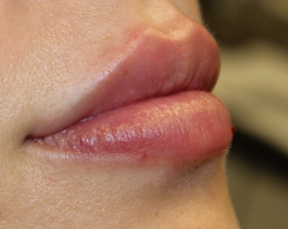 Lip Filler Before & After Patient #30466