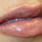 Lip Filler Before & After Patient #30358