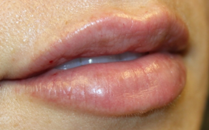 Lip Filler Before & After Patient #30358