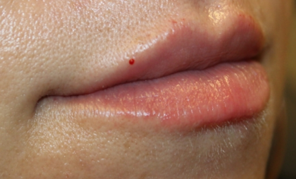 Lip Filler Before & After Patient #30426
