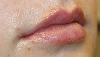 Lip Filler Before & After Patient #30341