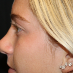 Rhinoplasty Before & After Patient #30417