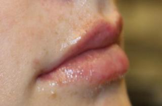 Lip Filler Before & After Patient #30341