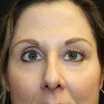 Blepharoplasty and Brow Lift Before & After Patient #30287