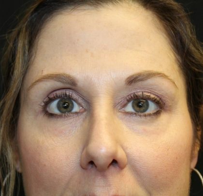 Blepharoplasty and Brow Lift Before & After Patient #30287