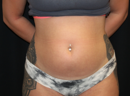 Liposuction Before & After Patient #30380