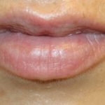 Lip Filler Before & After Patient #30358