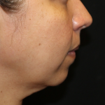 Injectable Fillers Before & After Patient #30408