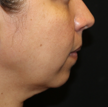 Injectable Fillers Before & After Patient #30408