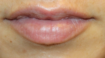 Lip Filler Before & After Patient #30358