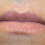 Lip Filler Before & After Patient #30426