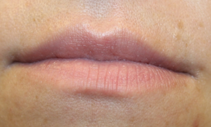 Lip Filler Before & After Patient #30426