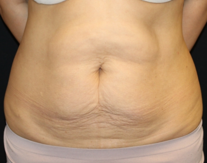 Tummy Tuck Before & After Patient #30433