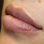 Lip Filler Before & After Patient #30466