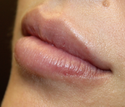 Lip Filler Before & After Patient #30466