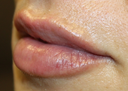 Lip Filler Before & After Patient #30358