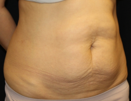 Tummy Tuck Before & After Patient #30433