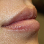 Lip Filler Before & After Patient #30466