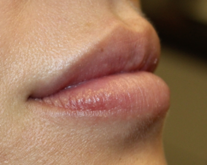 Lip Filler Before & After Patient #30466