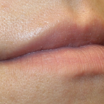 Lip Filler Before & After Patient #30426