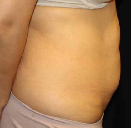 Tummy Tuck Before & After Patient #30433