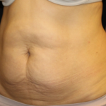 Tummy Tuck Before & After Patient #30433