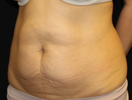 Tummy Tuck Before & After Patient #30433