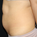 Tummy Tuck Before & After Patient #30433