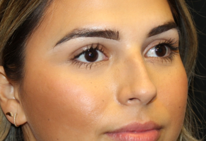 Rhinoplasty Before & After Patient #30392