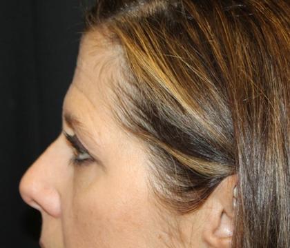 Blepharoplasty and Brow Lift Before & After Patient #30287