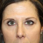 Blepharoplasty and Brow Lift Before & After Patient #30287