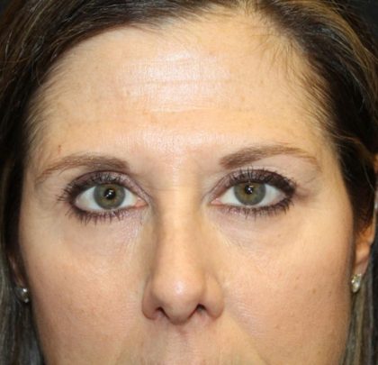Blepharoplasty and Brow Lift Before & After Patient #30287