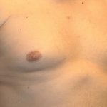 Gynecomastia Before & After Patient #30206