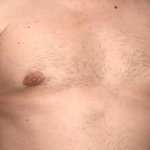 Gynecomastia Before & After Patient #30206