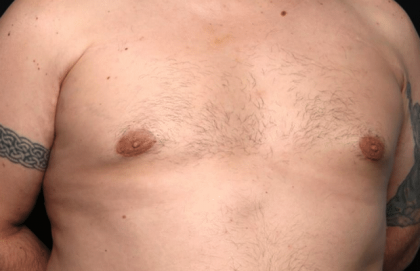 Gynecomastia Before & After Patient #30206