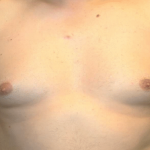 Gynecomastia Before & After Patient #30206