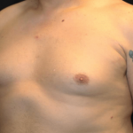 Gynecomastia Before & After Patient #30206