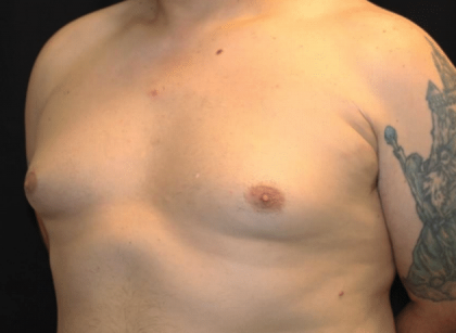 Gynecomastia Before & After Patient #30206