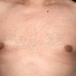 Gynecomastia Before & After Patient #30206