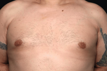 Gynecomastia Before & After Patient #30206