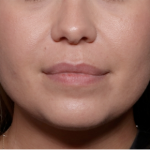 Injectable Fillers Before & After Patient #30453