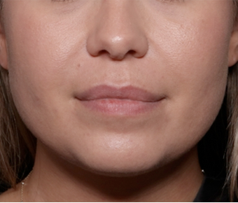 Injectable Fillers Before & After Patient #30453