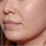 Injectable Fillers Before & After Patient #30453