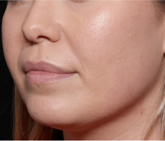 Injectable Fillers Before & After Patient #30453