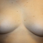 Nipple Revision Before & After Patient #30192
