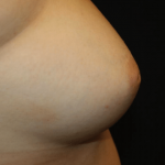 Nipple Revision Before & After Patient #30192