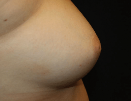 Nipple Revision Before & After Patient #30192